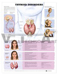 Thyroid Disorders Anatomical Chart